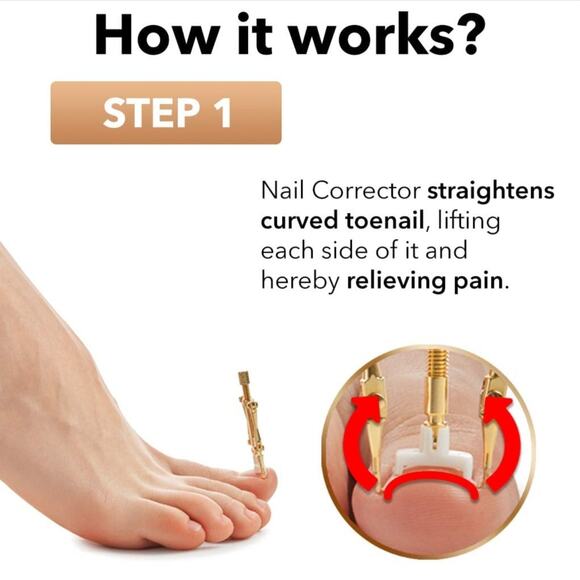 Ingrown Toenail Correction Kit- Dr. Krause- Nail Corrector New In Box - Picture 3 of 6